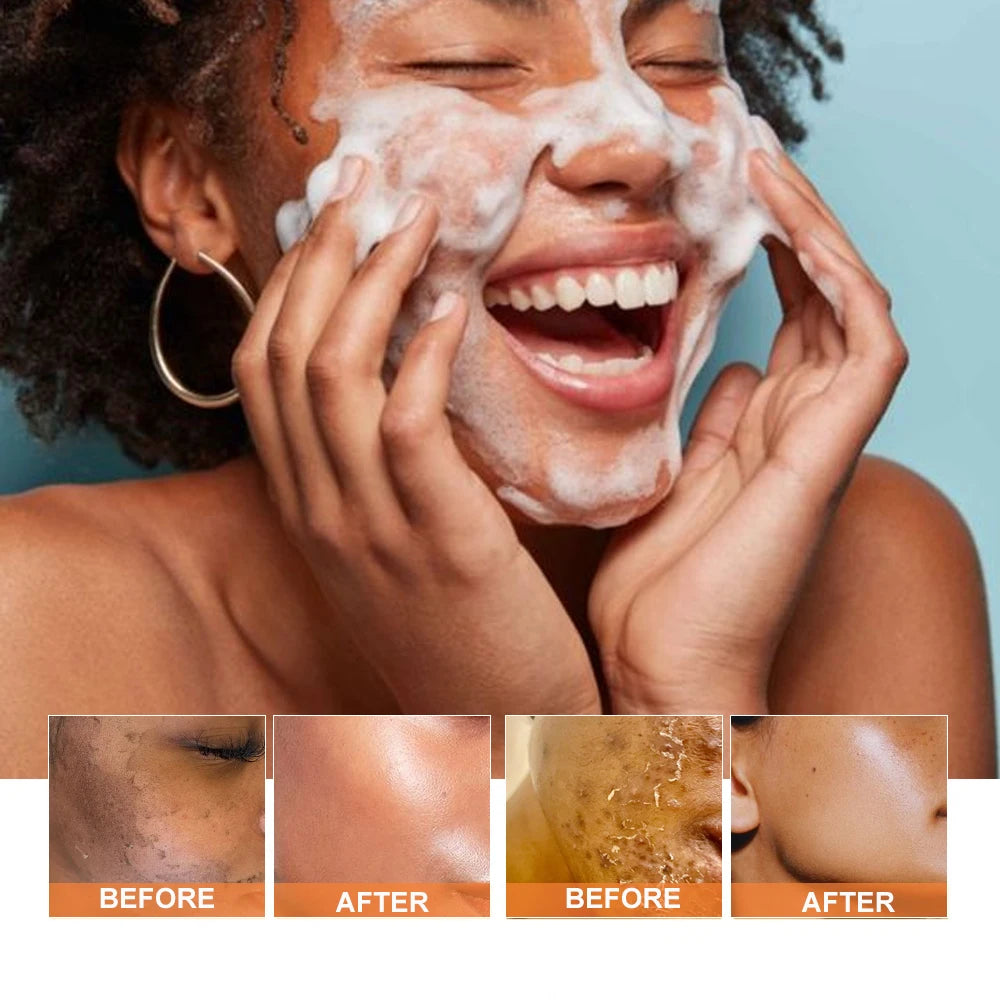 PHYSIA Adult Acne Removal Cleanser